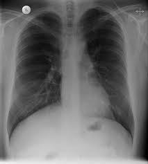 The rays pass through your chest and are absorbed on the film to create a picture. Imaging Of Congenital Chest Wall Deformities Abstract Europe Pmc