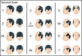 In men, the most common cause of hair loss is through a process called androgenic alopecia. Male Hair Loss Patterns Avrupa Sac Ekimi