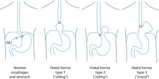 Utility Of Endoscopy In The Diagnosis Of Hiatus Hernia And Correlation With Gerd Abdominal Key