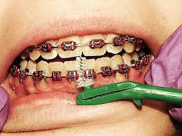 Remember, never brush side to side or vigorously as these habits can cause premature receding of the gums and increase the sensitivity of your teeth. Brushing And Flossing With Braces Dr Zia Beg Orthodontics