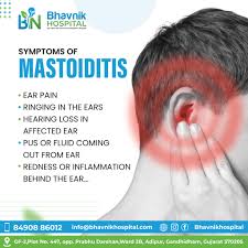 Image result for Mastoiditis