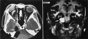 Image result for Meckel's Cave