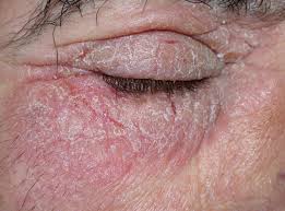 Image result for dermatitis contacta allergica