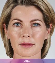 Yes, but more and more people are. Dermal Fillers For Scottsdale Phoenix Az Dr Todd Hobgood