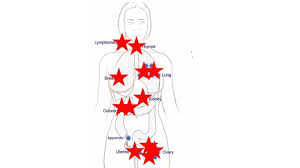 Learn more about laboratory tests and how they are used to diagnose cancer. First Study Of Multicancer Blood Test To Screen For Cancer Guide Intervention