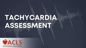 Image result for Synchronized Cardioversion