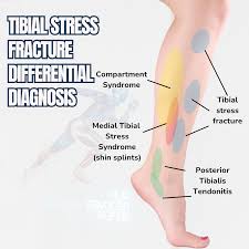 Image result for Tibia Stress Fracture