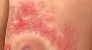 Image result for Inflammatory breast cancer