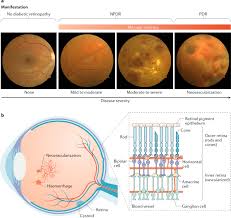 Find national data on vision and eye health. Current Understanding Of The Molecular And Cellular Pathology Of Diabetic Retinopathy Nature Reviews Endocrinology