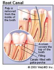 The root canal procedure allows the dentist to do the following: Root Canal Procedure For Infected Tooth Nerve Purpose Procedure Recovery