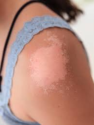 Dec 02, 2019 · apply a moisturizer to soothe and hydrate damaged skin, and help reduce the severity of peeling. Why Your Skin Peels After A Sunburn According To Dermatologists Allure