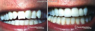 I think the better choice would be to a traditional dental veneer can be removed and replaced with another dental veneer, but a true return to the original dentition is not able to be achieved. Crooked Teeth Straightened With Instant Braces