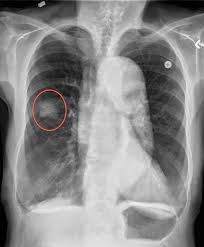 Image result for lung cancer xray