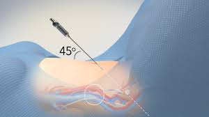 This method has been used in 15 patients and allowed the adhesions to be cleared where necessary. Abdominal Entry In Laparoscopic Gynecologic Surgery Tvasurg The Toronto Video Atlas Of Surgery