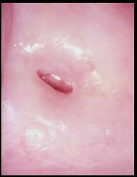 Cervical cancer causes and risk. Colposcopy Post Menopause The Challenges And Solutions Mobileodt