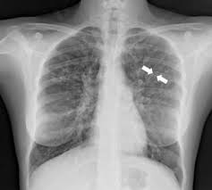 Bronquiectasia Disturbios Pulmonares Manuais Msd Edicao Para Profissionais
