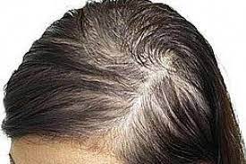 Pin On Hair Loss