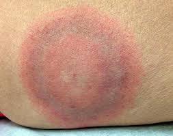 Na ljude se prenosi ubodom zaraženog krpelja. Borrelioza I Njezini Ugrizi Kolika Je Vjerojatnost Infekcije I Sto Uciniti Kako Bi Se Sprijecila Bolest