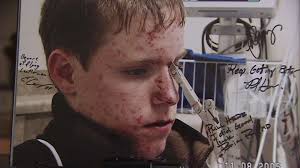 Teen Surprisingly Well After Getting Knife Lodged in Head