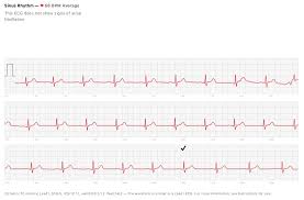 Inspect the image for artifact. Ecg Ekg Test Surprise You Did It Alert You On Issue Page 2 Macrumors Forums