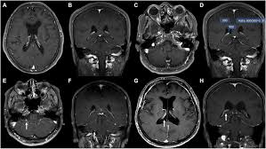 Mri is an important diagnostic tool for multiple sclerosis because it produces images of lesions in the brain and spinal cord. Choroid Plexus Changes On Magnetic Resonance Imaging In Multiple Sclerosis And Neuromyelitis Optica Spectrum Disorder Journal Of The Neurological Sciences