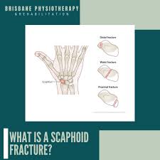 Image result for Scaphoid Fracture Signs