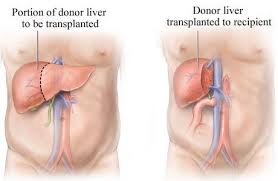 Image result for Transplantation