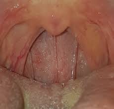 Image result for tonsilla palatina