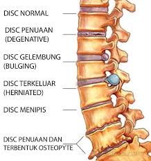 Korang tau tak apa itu slipped disc? Dr Suhazeli Viral Rawatan Tulang Belakang Ajaib Anda Tahu Apa Risikonya