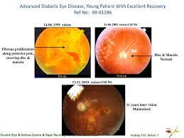 Learn more about the healthy people 2020 vision topic area. Drushti Eye And Retina Center Advanced Diabetic Eye Disease Young Patient With Excellent Recovery 2520ref No 9901196