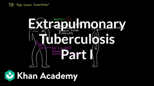 Image result for Extrapulmonary Tuberculosis
