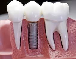 What is the procedure and aftercare of Dental implant surgery? -  missionimplantcenter