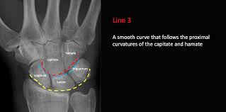 All carpal bones are irregularly cuboidal and therefore have six faces. Gilula S Carpal Arcs Resus