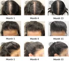 This condition typically manifests as a diffuse reduction of hair density over the frontal and vertex regions. Hair Growth Success Story Belgravia Has Allowed Me To Get My Confidence Back And Do So Many Different Hairstyles Also Just In Time For My Wedding