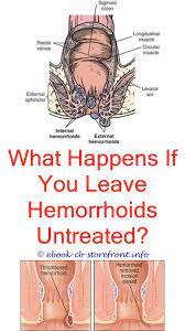 19 Enticing Hemorrhoid Types Of Ideas