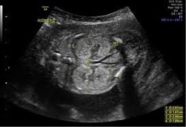 Your kidneys filter wastes and excess. Fetal Imaging Prompts Maternal Diagnosis Autosomal Dominant Polycystic Kidney Disease Journal Of Perinatology