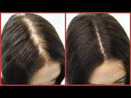 Ginkgo biloba is an herb that can help strengthen the hair shaft, which discourages hair thinning. How To Regrow Hair On Bald Spot Edges Thinning Hair Fast Hair Growth Khichi Beauty Youtube Regrow Hair Hairstyles For Thin Hair Hair Growth Faster