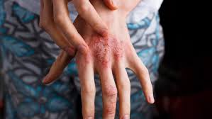 Affected areas of eczema usually appear very dry, thickened, or scaly. Types Of Eczema Atopic Dermatitis National Eczema Association