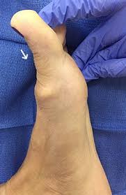 Pin On Bone Spurs