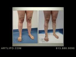 Lipo 360 Cankles Knees Ankles Calves Lipedema Treatment High Def L Lipedema Liposuction Lipedema Treatment