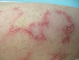 Lupus is a chronic autoimmune disease affecting about 1.5 million americans the condition often causes a rash, and many people fear catching a rash, but the rash that is associated with lupus is. Subacute Cutaneous Lupus Erythematosus Dermnet Nz