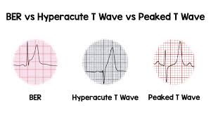Image result for Early Repolarization