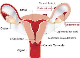 However, in rare cases it may also occur in other parts of the body. Endometriosi Non E Un Semplice Dolore Studio Kea