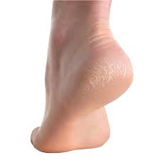 Image result for Anhidrosis