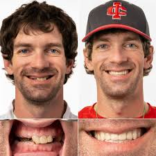 Full Mouth Implants in Jacksonville, FL