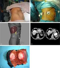 Valleylab, boulder, colorado), thunderbeat (olympus medical systems, corporation, tokyo, japan) and bipolar forceps. Laparoscopic Limited Liver Resection Decreases Morbidity Irrespective Of The Hepatic Segment Resected Sciencedirect