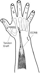 Common flexor tendon from the medial epicondyle of the humerus, ulnar collateral ligament of the elbow joint, and deep antebrachial fascia. Tendon Transfers Part Ii Transfers For Ulnar Nerve Palsy And Median Nerve Palsy Abstract Europe Pmc