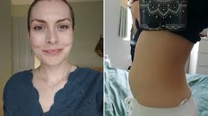 I ignored 'harmless' bloating for months until it was too late