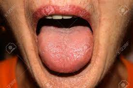 Candidiasis In Der Zunge Weisse Beschichtung Soor Lizenzfreie Fotos Bilder Und Stock Fotografie Image 81268806