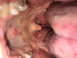 Image result for Puchýře na jazyku